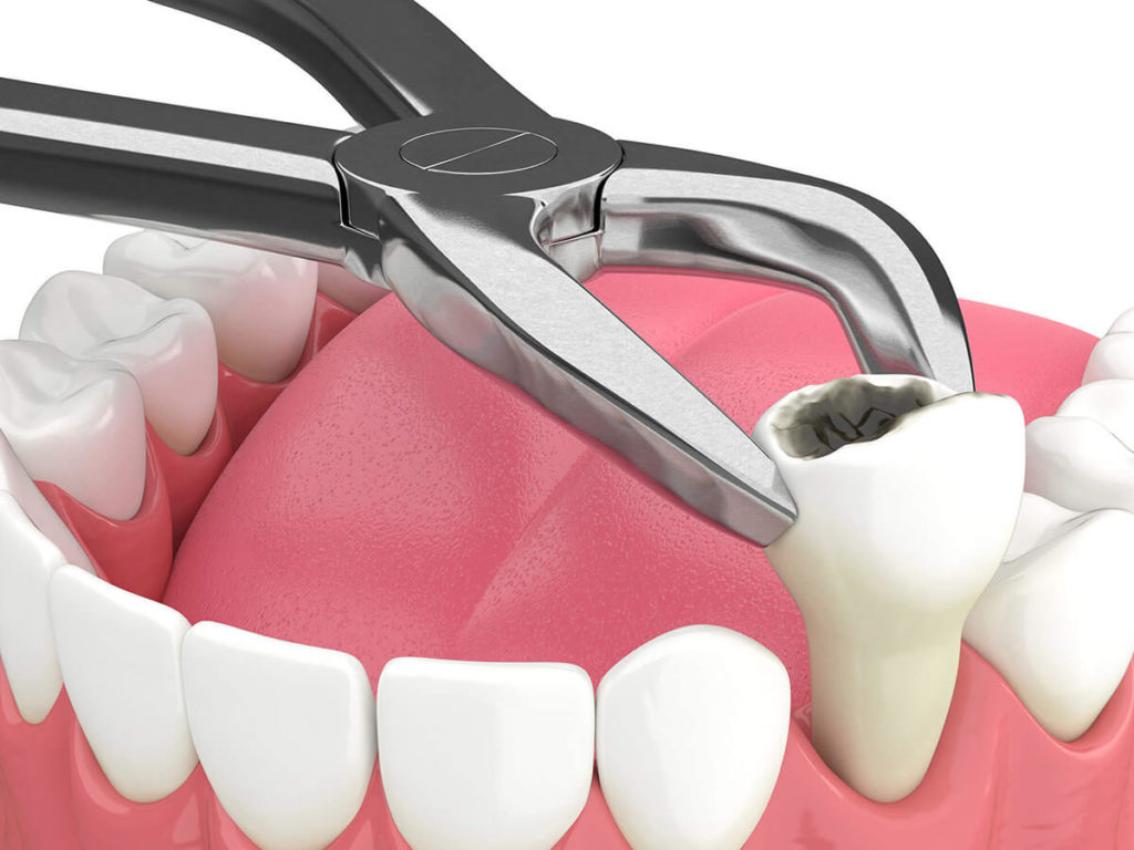 illustration of a tooth being extracted