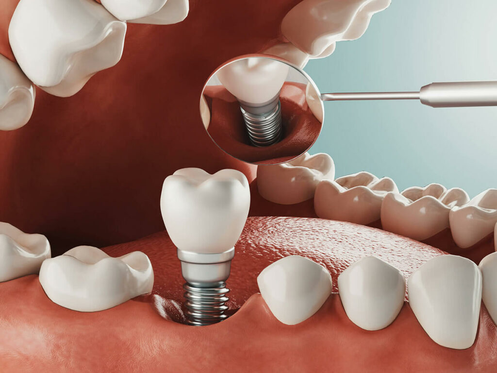 illustration of a dental implant being inserted into a jaw