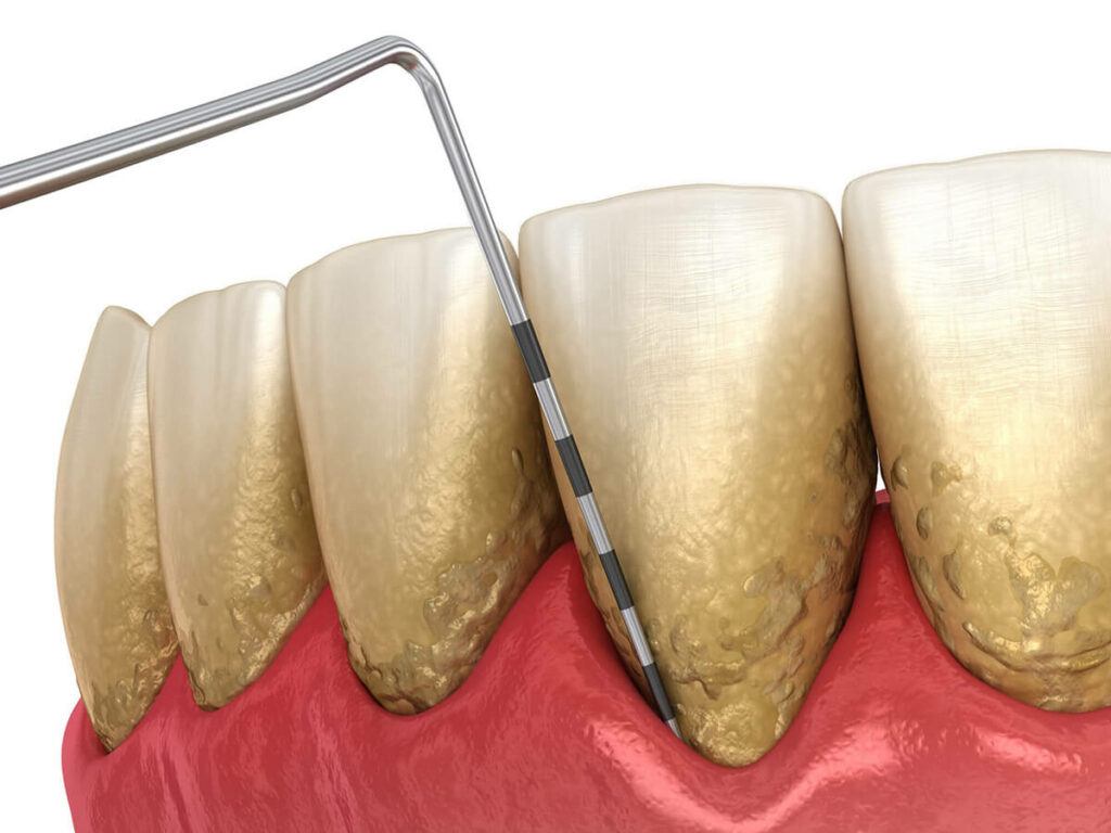 illustration of a dental tool treating gum disease