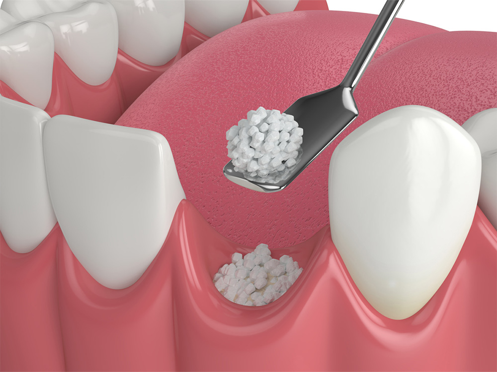 illustration of bone graft going into a tooth socket
