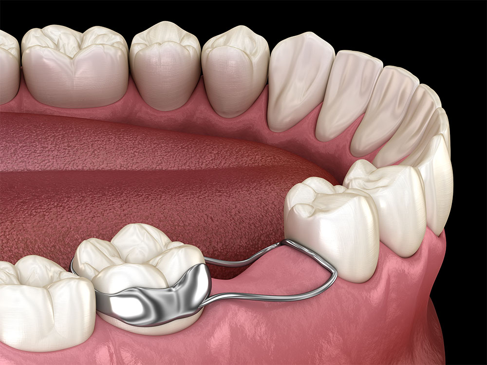 illustration of a space maintainer being used on the lower jaw