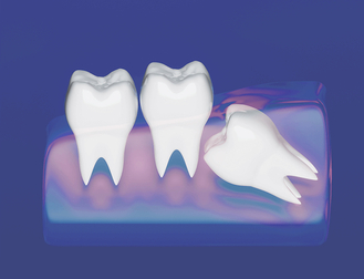 Illustration of three teeth, with one tooth lying horizontally and pressing against another upright tooth. This depiction demonstrates a common dental issue where a tooth, often a wisdom tooth, is impacted and does not have enough space to emerge properly.