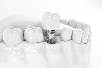 View from above of a false tooth implant fixed in the jawbone.