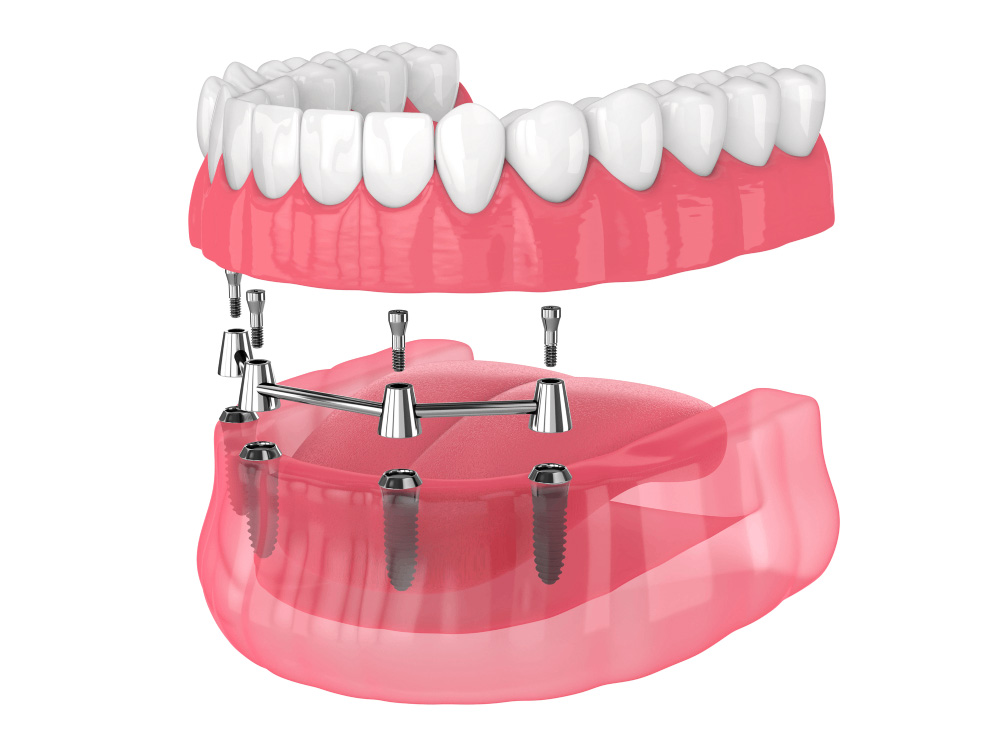 All-on-4® Dental Implants